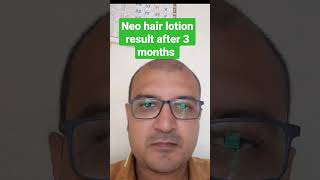 neo hair lotion result after 3 months [upl. by Nnauol]