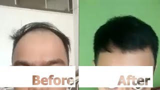 Review Neo Hair Lotion Hair Growth and Hair Root Nourishment Spray [upl. by Koa847]