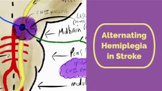 Alternating Hemiplegia in Stroke [upl. by Peale]