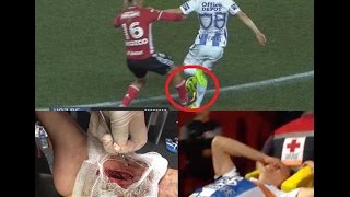 Terrible Lesión del CHUCKY Lozano  Horrible Injury [upl. by Melessa]