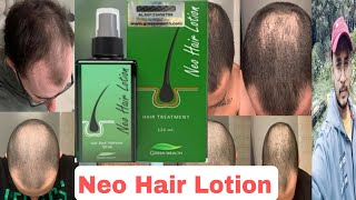 Neo Hair Lotion Review [upl. by Abagail]