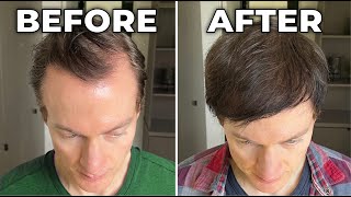 How I Reversed My Hair Loss  Greying [upl. by Flori]