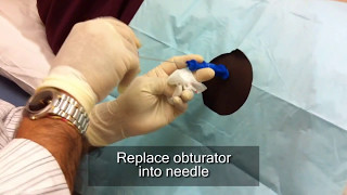 How Does a Needle Biopsy Work [upl. by Wobniar265]