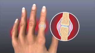 Rheumatoid Arthritis  Treatment  Johns Hopkins [upl. by Afihtan]