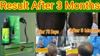 Neo Hair Lotion  Result After 3 Month hair treatment  shahidsialkoti [upl. by Paulson]