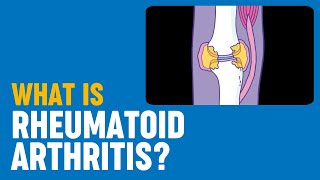 Rheumaliga Schweiz  Rheumatoide Arthritis [upl. by Terb]