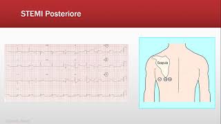 ECG Base Ischemia  Quiz FOAMed [upl. by Secnarf]