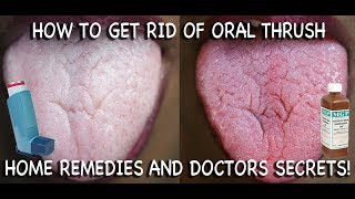 How to Treat Candida at Home Doctors Advice [upl. by Charleton556]