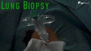 Surgical Breast Biopsy Options [upl. by Neral]