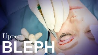 Upper Eyelid Blepharoplasty [upl. by Arun]