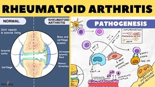 What is Rheumatoid Arthritis  RA Awareness Day 2017 [upl. by Marika]