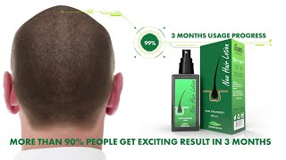 Green Wealth Neo Hair Lotion  3 Month Usage Progress [upl. by Comstock648]